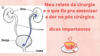 CIRURGIA DE CATETER DUPLO J MINHA EXPERIÊNCIA/+ DICAS