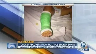 Toddler recovers from multiple broken bones