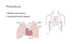 Heart and Lung Transplantation 3: Heart Transplantation (Part 2)