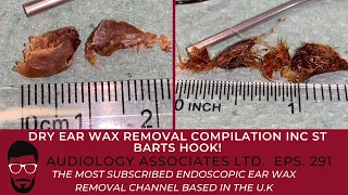 EAR WAX REMOVAL COMPILATION INC ST BARTS HOOK - EP291