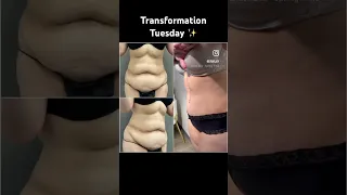 Tummy tuck transformation!