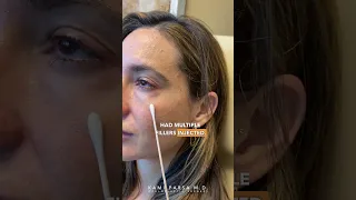 AVOID Tear Trough Fillers If You Have THIS... | Dr. Kami Parsa