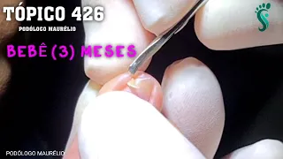 UNHA ENCRAVADA EM BEBÊ DE 3 MESES (3 MONTHS OLD BABY WITH INGROWN NAIL) - PODÓLOGO MAURÉLIO