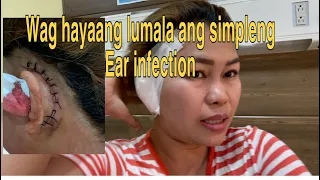 Paano nga ba maiiwasan ang Cholesteatoma(lalo sa mga bata na May ear infection)