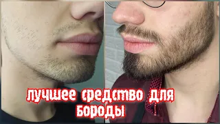 Миноксидил. Результат за 3 месяца. До и После. Minoxidil Kirkland 5%