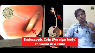 Endoscopic Coin (Foreign body) removal in a child