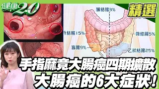 手指麻竟是大腸癌四期擴散 大腸癌的6大症狀! 年輕糖尿病患者當心大腸癌 好發期提前5年報到【健康2.0精選】