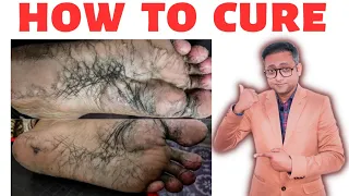 How to cure cracked sole permanently 🔥 | Hindi