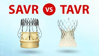 SAVR vs.  TAVR Patient Webinar: What Should Patients Know?