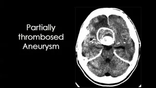 Imaging of Cerebral Vascular Malformations   Prof Dr  Mamdouh Mahfouz In Arabic