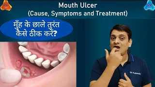 Mouth Ulcer | Treatment for Immediate Relief (By Dr. Puspendra)