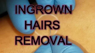 Ingrown Hair Removal I