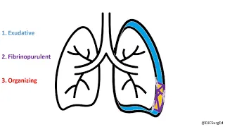 Empyema and Pleural Effusions