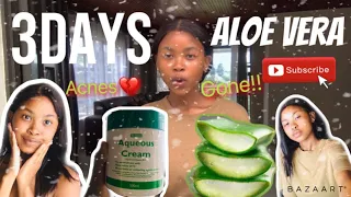 How I removed my Acnes in 3Days|Aloe Vera serum| Skincare & Cleaning| South African