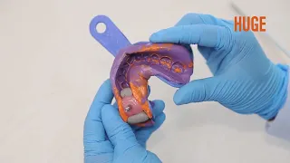 Dental Lab Procedure for Implant Restoration   Artificial Gum——Direct Technique