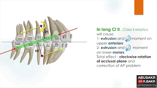 Long and short Class II elastics