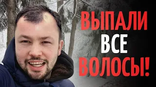 Выпали все волосы. Два месяца после пересадки