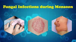 Fungal Infections During Monsoon | Types Of Fungal Infections | Overview of Fungal Skin Infections