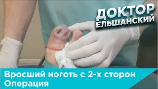 Вросший ноготь с 2-х сторон с гипергрануляциями, операция