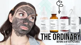 THE ORDINARY SKINCARE - How To Get Rid Of ACNE, ACNE SCARS & DARK SPOTS | BEFORE & AFTER PICTURES