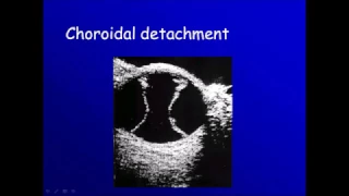 Ophthalmic ultrasonography: 4 choroidal detachment