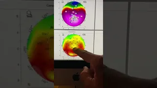 Pellucid marginal degeneration vs. Keratoconus diagnosis Kanellopoulos MD