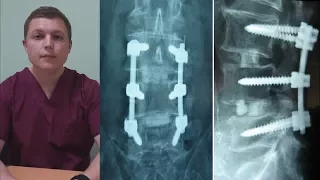 О минусах ТПФ операции | Spinal Fusion Is It Worth It?