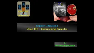 Ultrasound Case 116 - Necrotizing Fasciitis & Critical Limb Ischaemia