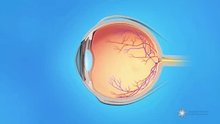 What is central retinal vein occlusion (CRVO)?