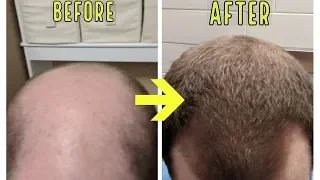 CRAZY MICRONEEDLING RESULTS TO STOP BALDING AND HAIR LOSS!