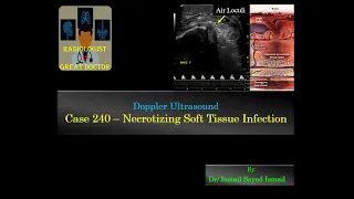 Ultrasound Case 240 - Necrotizing Soft Tissue Infection