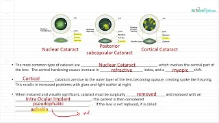 Optician Training: Cataracts (Ocular Anatomy Lecture 20)