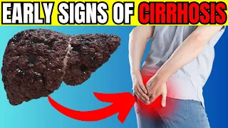 12 Early Signs of Liver CIRRHOSIS | LIVER is DYING!