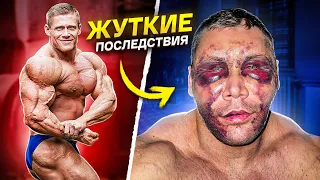 КАЧОК ИСПОРТИЛ СЕБЕ ЛИЦО / последствия фейслифтинга