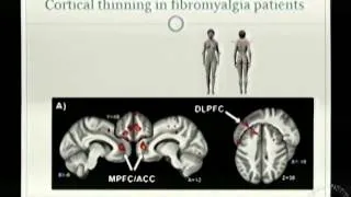 Brain Changes in Chronic Pain Patients