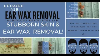 STUBBORN SKIN & EAR WAX REMOVAL - EP 459