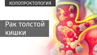 Рак толстой кишки | Частная патология