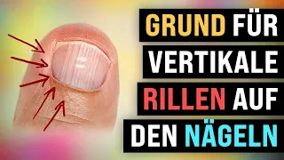 Hast du vertikale Rillen auf deinen Nägeln? (5 Ursachen)