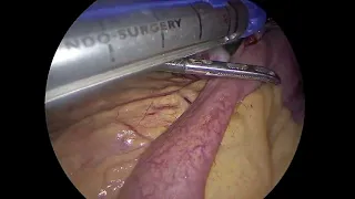 MGB( Mini Gastric Bypass)