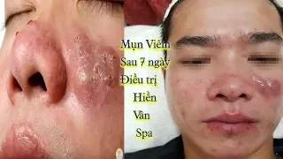 Điều trị Mụn Viêm-Mụn Bọc Hiệu quả Tại Hiền Vân Spa ( bài 230)