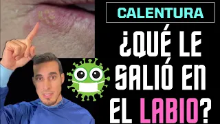 Seguramente hayas tenido este VIRUS e INFECCIÓN  - FUEGOS en la BOCA O HERPES EN LABIO