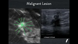 Breast Ultrasound Part 1