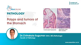 Polyps and tumors of the Stomach #pathology #polyps #tumor