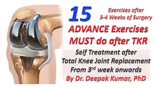 Advance Exercise after 1 Month of TKR | Total Knee Replacement | 15 Best Self Exercises for Knee |