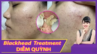 Blackhead Acne Removal| Điều trị mụn hiệu quả số 1 TPHCM| Hiền Vân Spa | Võ Diễm Quỳnh |554