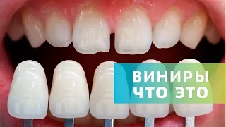 Виниры. Зачем, когда и где устанавливать | Что такое виниры | Дентал ТВ