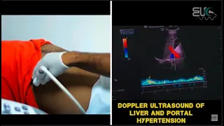 Liver Doppler Ultrasound