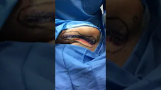 W-plasty Scar Revision with AFT & Laser LipoSculpture of Outer Thighs (Part 3)