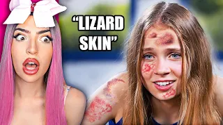 Kids MAKE FUN of Girl's Skin Condition.. What's Next Is Shocking