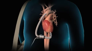 Left Ventricular Assist Device | LVAD | Nucleus Health